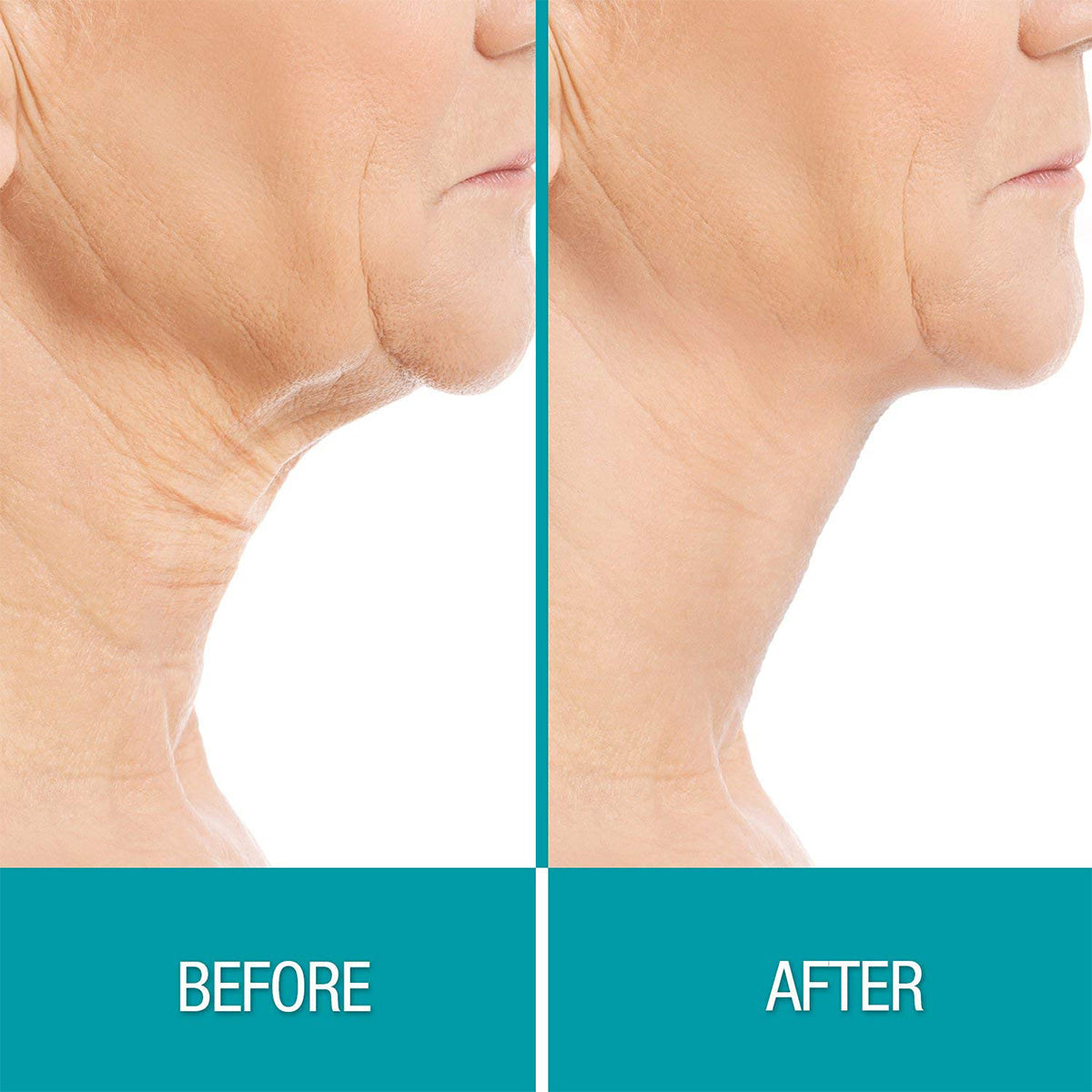 Fat Freezer Chin and Neck Sculpting System